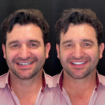 Exemplo em Lentes de Contato Dentais em Porcelana (Facetas)