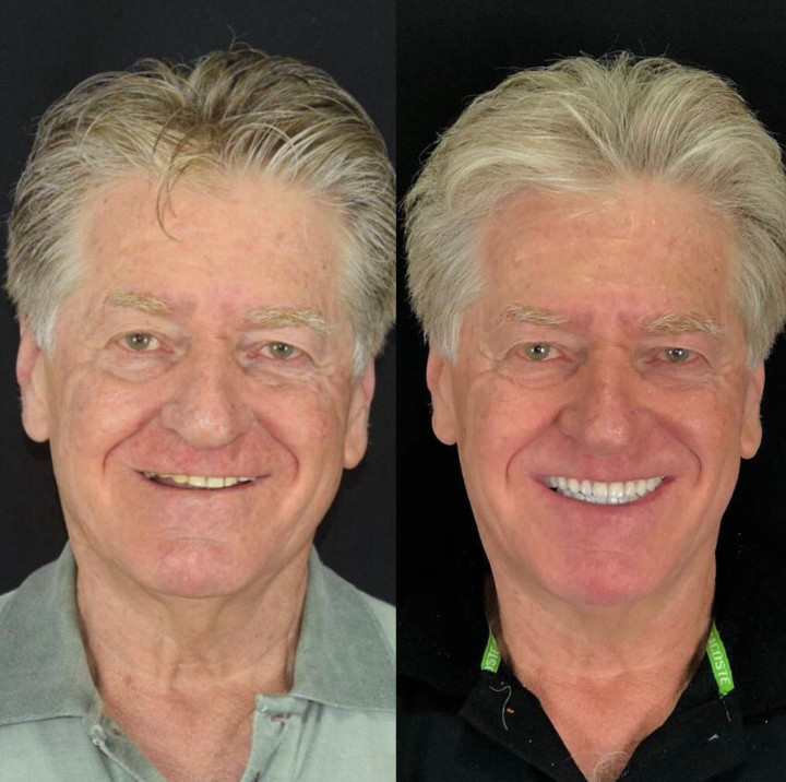 Foto Tratamento Implantes e Reabilitação Oral Implantes e Reabilitação Oral