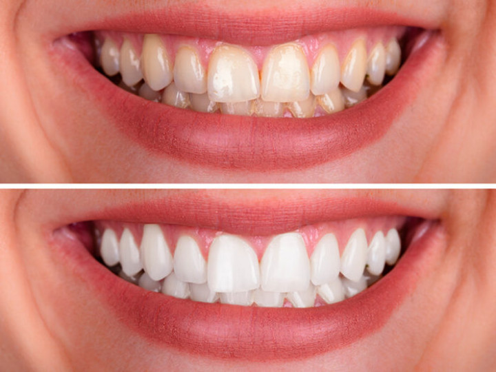 Foto Tratamento Clareamento Dental