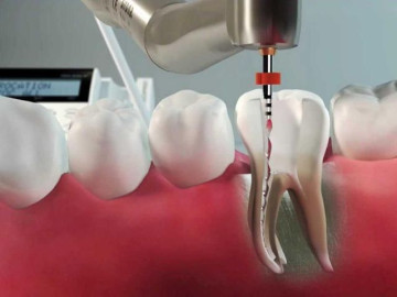 Tratamento de canal (endodontia) Tratamento de canal (endodontia)