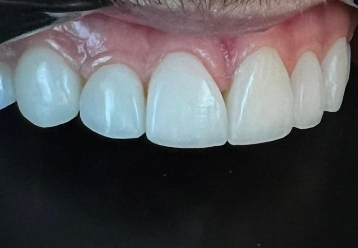 Foto Tratamento Lentes e Facetas Em Resina Lentes e Facetas Em Resina